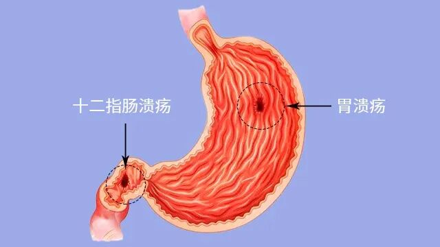 健康科普 | 关于消化性溃疡，你需要知道这些