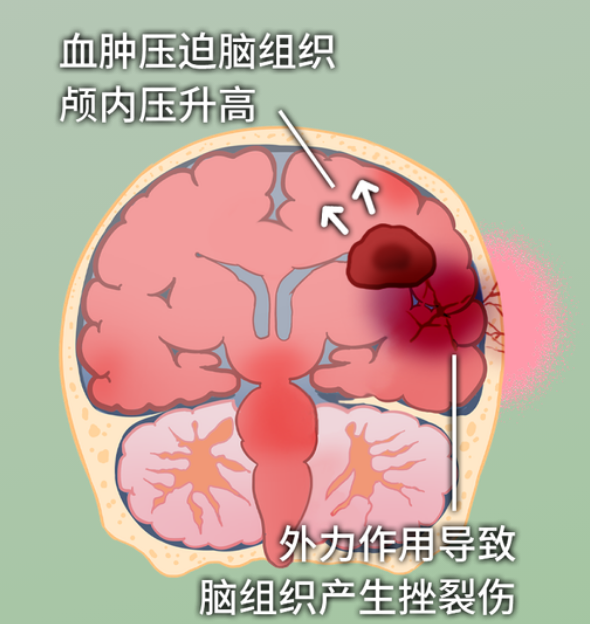 健康科普｜关于颅脑损伤，每个人都该知道的保命常识